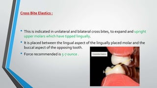 Cross Bite Elastics :
• This is indicated in unilateral and bilateral cross bites, to expand and upright
upper molars which have tipped lingually.
• It is placed between the lingual aspect of the lingually placed molar and the
buccal aspect of the opposing tooth.
• Force recommended is 5-7 ounce .
 