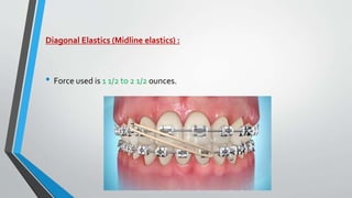 Diagonal Elastics (Midline elastics) :
• Force used is 1 1/2 to 2 1/2 ounces.
 
