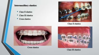 Proper _ Elastics _ in _ orthontics .pptx