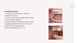 Comprehensive Overview of Orthodontic Elastics: Types, Uses, and ...
