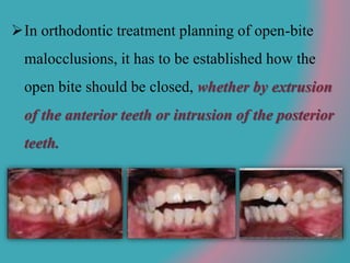 In orthodontic treatment planning of open-bite
malocclusions, it has to be established how the
open bite should be closed, whether by extrusion
of the anterior teeth or intrusion of the posterior
teeth.
 