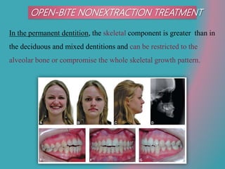 OPEN-BITE NONEXTRACTION TREATMENT
In the permanent dentition, the skeletal component is greater than in
the deciduous and mixed dentitions and can be restricted to the
alveolar bone or compromise the whole skeletal growth pattern.
 