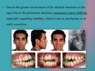 • Due to the greater involvement of the skeletal structures in the
open bite in the permanent dentition, treatment is more difficult,
especially regarding stability, which is not as satisfactory as in
early correction .
 