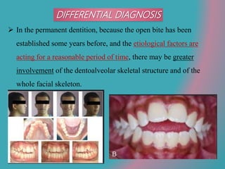 DIFFERENTIAL DIAGNOSIS
 In the permanent dentition, because the open bite has been
established some years before, and the etiological factors are
acting for a reasonable period of time, there may be greater
involvement of the dentoalveolar skeletal structure and of the
whole facial skeleton.
 