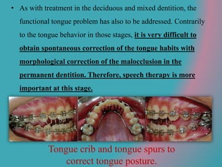 Tongue crib and tongue spurs to
correct tongue posture.
• As with treatment in the deciduous and mixed dentition, the
functional tongue problem has also to be addressed. Contrarily
to the tongue behavior in those stages, it is very difficult to
obtain spontaneous correction of the tongue habits with
morphological correction of the malocclusion in the
permanent dentition. Therefore, speech therapy is more
important at this stage.
 