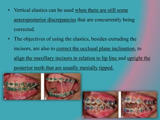 • Vertical elastics can be used when there are still some
anteroposterior discrepancies that are concurrently being
corrected.
• The objectives of using the elastics, besides extruding the
incisors, are also to correct the occlusal plane inclination, to
align the maxillary incisors in relation to lip line and upright the
posterior teeth that are usually mesially tipped.
 