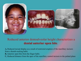 Reduced anterior dentoalveolar height characterizes a
dental anterior open bite.
A, Reduced incisal display as a result of restricted eruption of the maxillary incisors
from a thumb-sucking habit.
B, Anterior open bite from the finger habit.
C, Reduced distance from the apex of the maxillary central incisors to the palatal plane
 