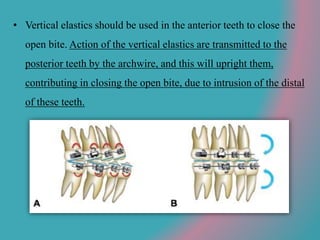• Vertical elastics should be used in the anterior teeth to close the
open bite. Action of the vertical elastics are transmitted to the
posterior teeth by the archwire, and this will upright them,
contributing in closing the open bite, due to intrusion of the distal
of these teeth.
 