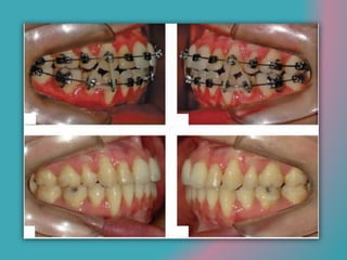 Elastics for open bite treatment