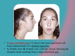 • A large interlabial gap (>3 mm) is the most significant soft
tissue characteristic of a skeletal open bite.
• A, Profile view. B, Frontal view with lips closed, showing the
mentalis strain resulting from a large interlabial gap.
 