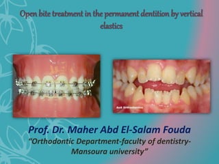 Open bite treatment in the permanent dentition by vertical
elastics
Prof. Dr. Maher Abd El-Salam Fouda
“Orthodontic Department-faculty of dentistry-
Mansoura university”
 