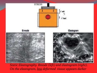 STRESS

Static Elastography. Bmode (left) and elastogram (right).
On the elastogram, less deformed tissue appears darker

 