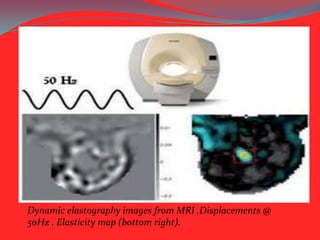 Dynamic elastography images from MRI .Displacements @
50Hz . Elasticity map (bottom right).

 