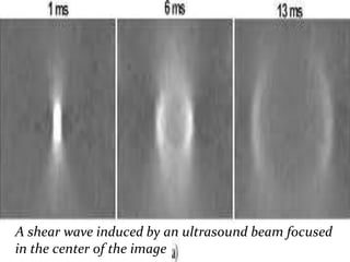 A shear wave induced by an ultrasound beam focused
in the center of the image

 