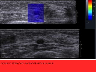 COMPLICATED CYST- HOMOGENEOUSLY BLUE

 
