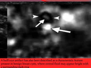 A bull’s eye artifact has also been described as a characteristic feature
present in benign breast cysts, where central fluid may appear bright with
a surrounding dark ring

 
