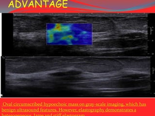 ADVANTAGE

Oval circumscribed hypoechoic mass on gray-scale imaging, which has
benign ultrasound features. However, elastography demonstrates a

 
