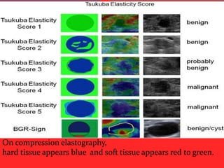 On compression elastography,
hard tissue appears blue and soft tissue appears red to green.

 