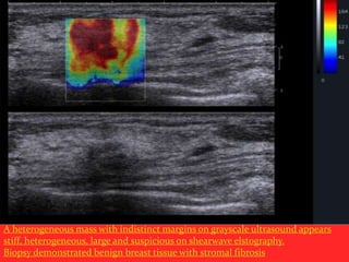 A heterogeneous mass with indistinct margins on grayscale ultrasound appears
stiff, heterogeneous, large and suspicious on shearwave elstography.
Biopsy demonstrated benign breast tissue with stromal fibrosis

 