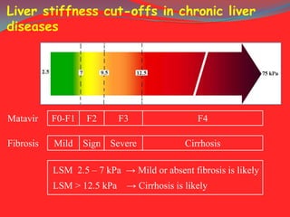 Liver stiffness cut-offs in chronic liver
diseases

Matavir

F0-F1

Fibrosis

Mild

F2

F3

Sign Severe

F4

Cirrhosis

LSM 2.5 – 7 kPa → Mild or absent fibrosis is likely

LSM > 12.5 kPa → Cirrhosis is likely

 