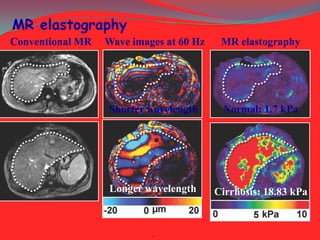 MR elastography
Conventional MR

Wave images at 60 Hz

MR elastography

Shorter wavelength

Normal: 1.7 kPa

Longer wavelength

Cirrhosis: 18.83 kPa

.

 
