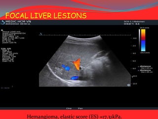 FOCAL LIVER LESIONS

Hemangioma, elastic score (ES) =17.31kPa.

 