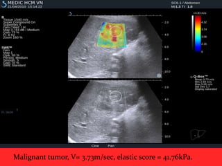 Malignant tumor, V= 3.73m/sec, elastic score = 41.76kPa.

 
