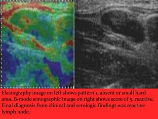 Elastography image on left shows pattern 1, absent or small hard
area. B-mode sonographic image on right shows score of 5, reactive.
Final diagnosis from clinical and serologic findings was reactive
lymph node.

 