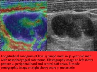 Longitudinal sonogram of level 5 lymph node in 52-year-old man
with nasopharyngeal carcinoma. Elastography image on left shows
pattern 4, peripheral hard and central soft areas. B-mode
sonographic image on right shows score 7, metastatic

 