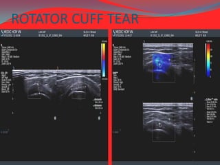 ROTATOR CUFF TEAR

 