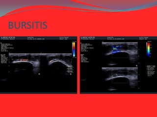 BURSITIS

 