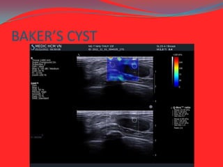BAKER’S CYST

 