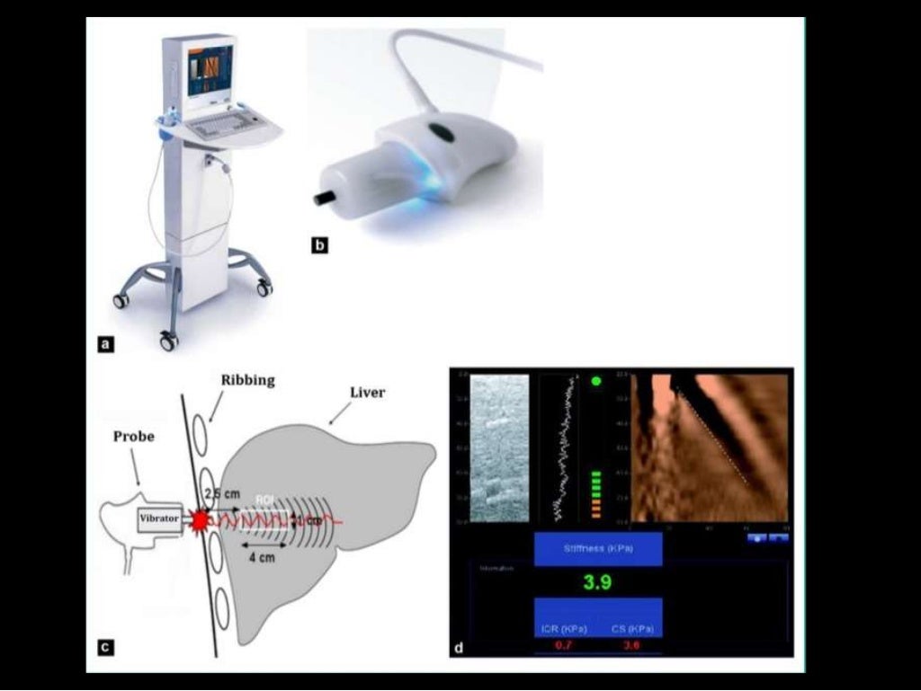 Shear wave Elastography of Liver
