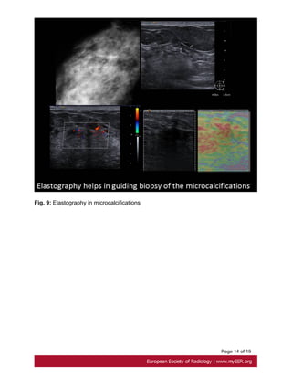 Elastography: An Additional Tool for Characterisation of Breast Lesions ...