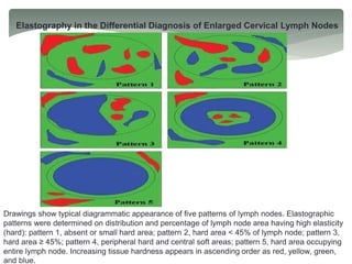 Elastography in the Differential Diagnosis of Enlarged Cervical Lymph Nodes
Drawings show typical diagrammatic appearance of five patterns of lymph nodes. Elastographic
patterns were determined on distribution and percentage of lymph node area having high elasticity
(hard): pattern 1, absent or small hard area; pattern 2, hard area < 45% of lymph node; pattern 3,
hard area ≥ 45%; pattern 4, peripheral hard and central soft areas; pattern 5, hard area occupying
entire lymph node. Increasing tissue hardness appears in ascending order as red, yellow, green,
and blue.
 