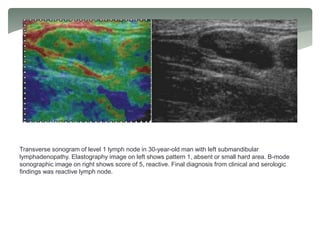 Transverse sonogram of level 1 lymph node in 30-year-old man with left submandibular
lymphadenopathy. Elastography image on left shows pattern 1, absent or small hard area. B-mode
sonographic image on right shows score of 5, reactive. Final diagnosis from clinical and serologic
findings was reactive lymph node.
 