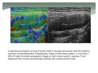 Longitudinal sonogram of level 2 lymph node in 33-year-old woman with left posterior
auricular lymphadenopathy. Elastography image on left shows pattern 2, hard area <
45% of node. B-mode sonographic image on right shows score 5, reactive. Final
diagnosis from clinical and serologic findings was reactive lymph node.
 