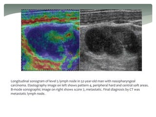 Longitudinal sonogram of level 5 lymph node in 52-year-old man with nasopharyngeal
carcinoma. Elastography image on left shows pattern 4, peripheral hard and central soft areas.
B-mode sonographic image on right shows score 7, metastatic. Final diagnosis by CT was
metastatic lymph node.
 