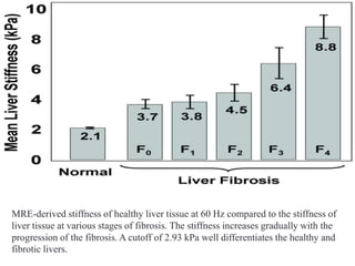 MRE-derived stiffness of healthy liver tissue at 60 Hz compared to the stiffness of
liver tissue at various stages of fibrosis. The stiffness increases gradually with the
progression of the fibrosis. A cutoff of 2.93 kPa well differentiates the healthy and
fibrotic livers.
 