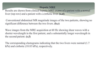 Hepatic MRE
Results are shown from clinical hepatic MRE exams of a patient with a normal
liver (top row) and a patient with a cirrhotic liver. (a,d)
Conventional abdominal MR magnitude images of the two patients, showing no
significant difference between the two livers. (b,e)
Wave images from the MRE acquisition at 60 Hz showing shear waves with a
shorter wavelength in the first patient, and a substantially longer wavelength in
the second patient. (c,f)
The corresponding elastograms indicating that the two livers were normal (1.7
kPa) and cirrhotic (18.83 kPa), respectively.
 