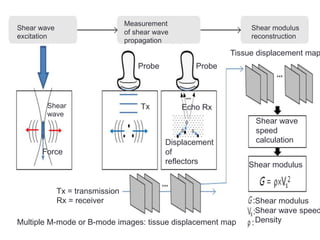 Shear wave
excitation
Measurement
of shear wave
propagation
Shear modulus
reconstruction
Shear
wave
Force
Probe Probe
Tx Echo Rx
Displacement
of
reflectors
Tissue displacement map
Shear wave
speed
calculation
Shear modulus
Shear modulus
Shear wave speed
Density
Tx = transmission
Rx = receiver
Multiple M-mode or B-mode images: tissue displacement map
 