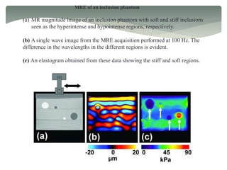 MRE of an inclusion phantom
(a) MR magnitude image of an inclusion phantom with soft and stiff inclusions
seen as the hyperintense and hypointense regions, respectively.
(b) A single wave image from the MRE acquisition performed at 100 Hz. The
difference in the wavelengths in the different regions is evident.
(c) An elastogram obtained from these data showing the stiff and soft regions.
 