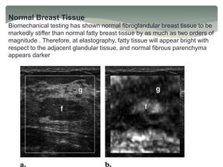 Normal Breast Tissue
Biomechanical testing has shown normal fibroglandular breast tissue to be
markedly stiffer than normal fatty breast tissue by as much as two orders of
magnitude . Therefore, at elastography, fatty tissue will appear bright with
respect to the adjacent glandular tissue, and normal fibrous parenchyma
appears darker
 