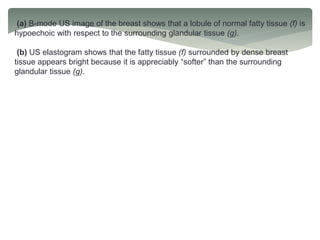 (a) B-mode US image of the breast shows that a lobule of normal fatty tissue (f) is
hypoechoic with respect to the surrounding glandular tissue (g).
(b) US elastogram shows that the fatty tissue (f) surrounded by dense breast
tissue appears bright because it is appreciably “softer” than the surrounding
glandular tissue (g).
 