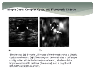Simple cyst. (a) B-mode US image of the breast shows a classic
cyst (arrowheads). (b) US elastogram demonstrates a bull’s-eye
configuration within the lesion (arrowheads), which contains
bright compressible material (thin arrow), and a bright spot
behind the cyst (thick arrow).
 