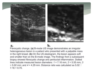 Fibrocystic change. (a) B-mode US image demonstrates an irregular
heterogeneous lesion in a patient who presented with a palpable mass
in the right breast. (b) On the US elastogram, the lesion appears soft
and smaller than on the B-mode image. The findings from a subsequent
biopsy showed fibrocystic change and periductal inflammation. Dotted
lines indicate measured lesion diameters: 1 = 7.16 mm; 2 = 5.55 mm; 3
= 5.02 mm; and 4 = 4.29 mm. Distance ratio was calculated as 5.02 
7.16 = 0.70.
 