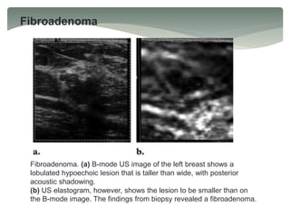 Fibroadenoma
Fibroadenoma. (a) B-mode US image of the left breast shows a
lobulated hypoechoic lesion that is taller than wide, with posterior
acoustic shadowing.
(b) US elastogram, however, shows the lesion to be smaller than on
the B-mode image. The findings from biopsy revealed a fibroadenoma.
 