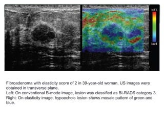 Fibroadenoma with elasticity score of 2 in 39-year-old woman. US images were
obtained in transverse plane.
Left: On conventional B-mode image, lesion was classified as BI-RADS category 3.
Right: On elasticity image, hypoechoic lesion shows mosaic pattern of green and
blue.
 