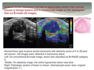 invasive ductal carcinoma typically is appreciably darker than normal
tissues or benign lesions and is substantially larger on the elastogram
than on B-mode US images
Nonscirrhous type invasive ductal carcinoma with elasticity score of 4 in 29-year
old woman. US images were obtained in transverse plane.
Left: On conventional B-mode image, lesion was classified as BI-RADS category
5.
Middle: On elasticity image, the entire hypoechoic lesion was blue.
Right: Pathologic section of lesion is shown. (Hematoxylin-eosin stain; original
magnification,1.)
 