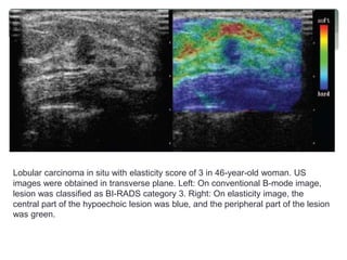 Lobular carcinoma in situ with elasticity score of 3 in 46-year-old woman. US
images were obtained in transverse plane. Left: On conventional B-mode image,
lesion was classified as BI-RADS category 3. Right: On elasticity image, the
central part of the hypoechoic lesion was blue, and the peripheral part of the lesion
was green.
 